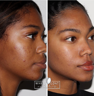 Before and after Skin Treatment | White Coat Aesthetics in Las Vegas, NV