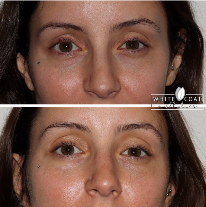 Young Woman Before and After PRP Treatment Photos in Las Vegas, NV | White Coat Aesthetics