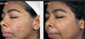 Woman Before and After DiamondGlow Treatment Photos in Las Vegas, NV | White Coat Aesthetics