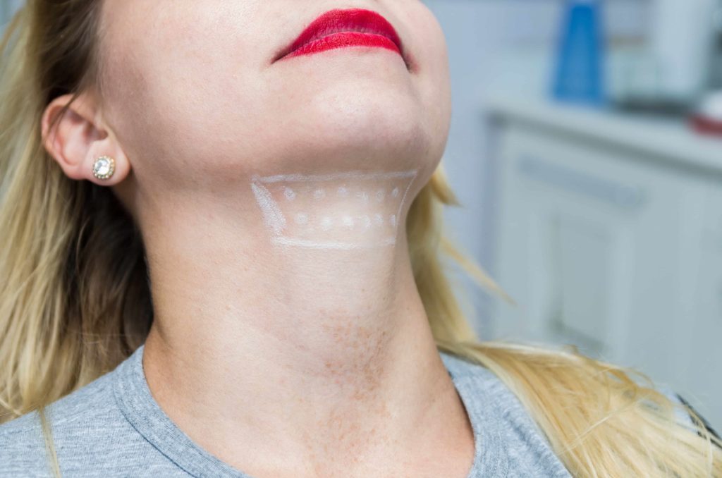 Kybella treatment marks on a female chin | White Coat Aesthetics in Las Vegas, NV