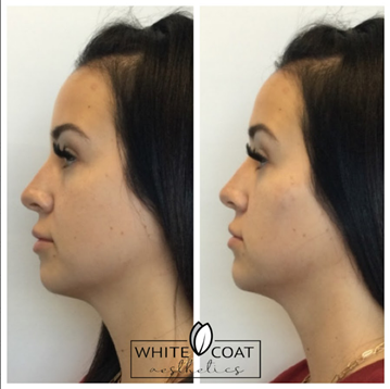 Chin and Cheek Filler Before and After Treatment | White Coat Aesthetics in Las Vegas, NV