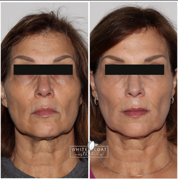 Before and After marionette line filler Treatment Results of a female | White Coat Aesthetics in Las Vegas, NV