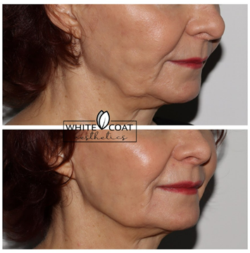 Before and After jawline filler Treatment Results of a female | White Coat Aesthetics in Las Vegas, NV