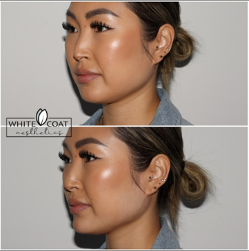 Before and After jawline filler Treatment Results of a female | White Coat Aesthetics in Las Vegas, NV