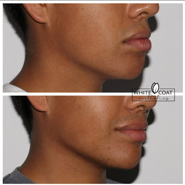 Before and After jawline filler Treatment Results | White Coat Aesthetics in Las Vegas, NV