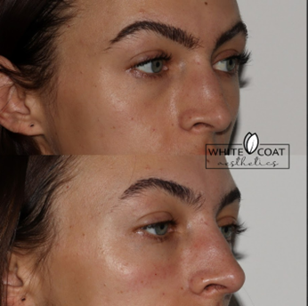 Before and After under eye filler Treatment Results of a woman | White Coat Aesthetics in Las Vegas, NV