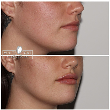 Before and After lip filler Treatment Results of a woman | White Coat Aesthetics in Las Vegas, NV