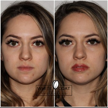 Before and After lip filler Treatment Results of a woman | White Coat Aesthetics in Las Vegas, NV