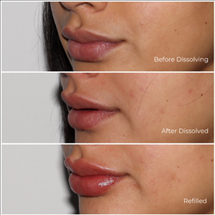 Before and After lip rehab Treatment Results of a woman | White Coat Aesthetics in Las Vegas, NV