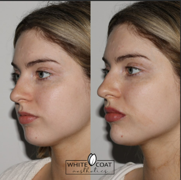Before and After chin filler Treatment Results of a female | White Coat Aesthetics in Las Vegas, NV