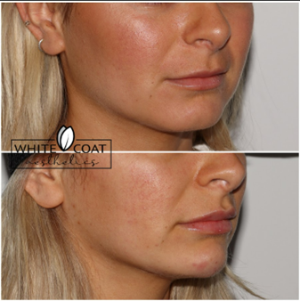 Before and After chin filler Treatment Results of a female | White Coat Aesthetics in Las Vegas, NV