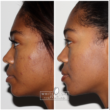 Before and After acne dual-light Treatment Results of a female | White Coat Aesthetics in Las Vegas, NV