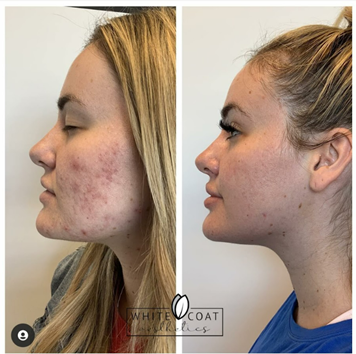 Before and After acne dual-light Treatment Results of a female | White Coat Aesthetics in Las Vegas, NV