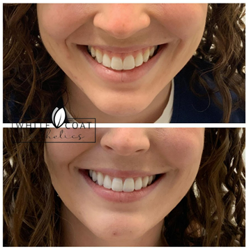 Before and After gummy smile Treatment Results of a female | White Coat Aesthetics in Las Vegas, NV