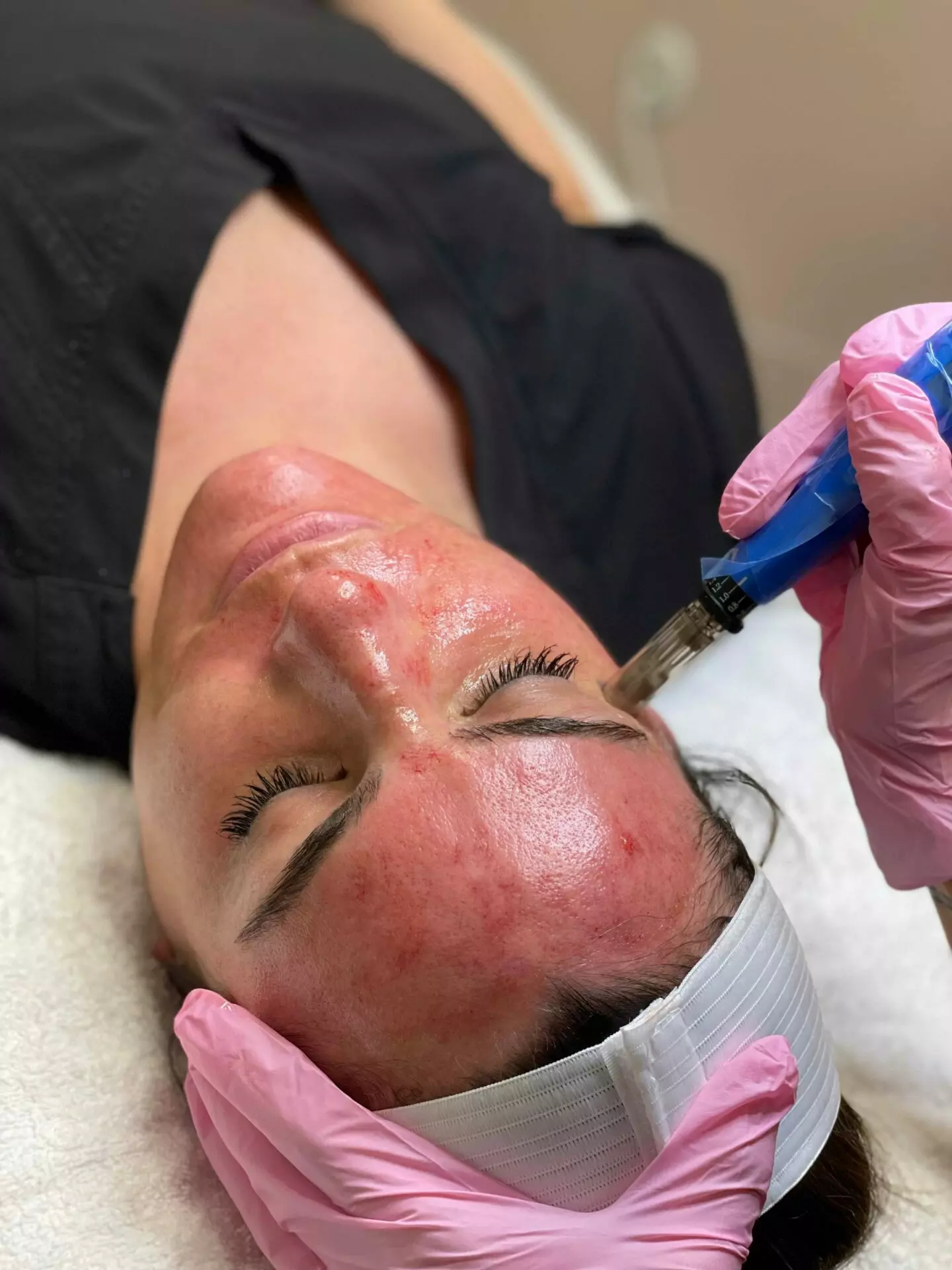 Microneedling Treatment at White Coat Aesthetics in Las Vegas, NV