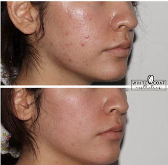 Before and after Skin Treatment | White Coat Aesthetics in Las Vegas, NV