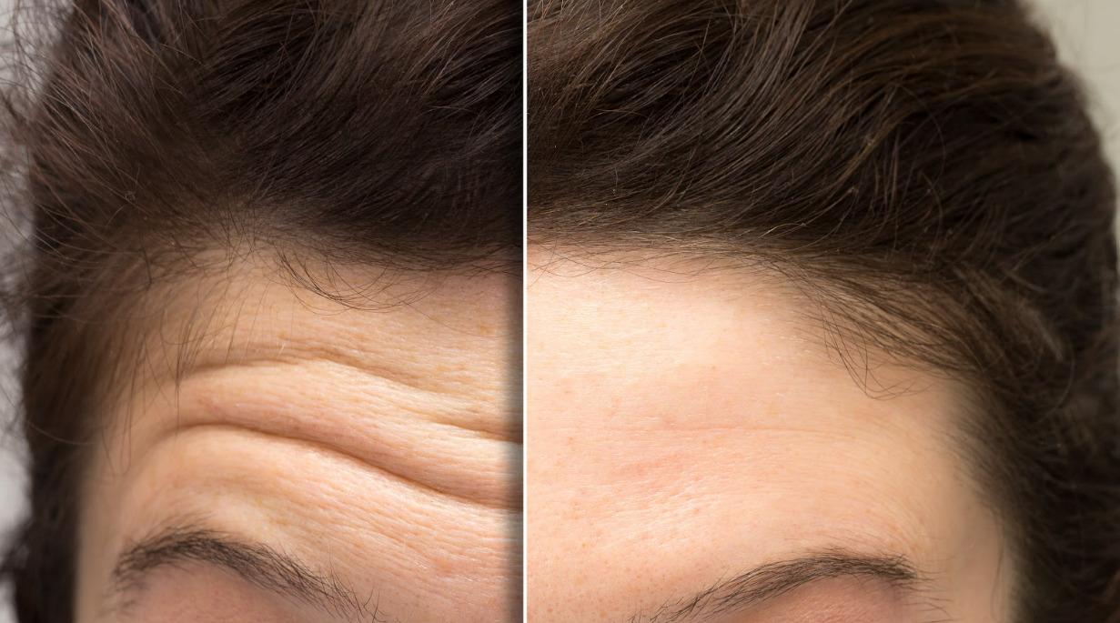 Before & After Treatment Image | White Coat Aesthetics in Las Vegas, NV