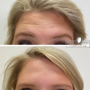Young Woman Before and After Botox Treatment Photos in Las Vegas, NV | White Coat Aesthetics