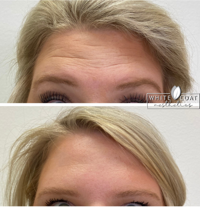 Young Woman Before and After Botox Treatment Photos in Las Vegas, NV | White Coat Aesthetics