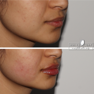 Young Girl Before and After Lip Filler Treatment Photos in Las Vegas, NV | White Coat Aesthetics