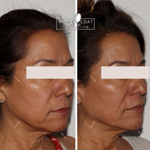 Woman Before and After Filler Treatment Photos in Las Vegas, NV | White Coat Aesthetics