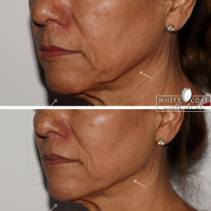 Woman Before and After Jawline Filler Treatment Photos in Las Vegas, NV | White Coat Aesthetics