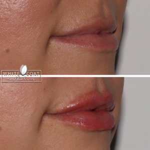 Young Woman Before and After Lip Filler Treatment Photos in Las Vegas, NV | White Coat Aesthetics