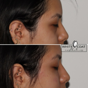 Young Girl Before and After Filler Treatment Photos in Las Vegas, NV | White Coat Aesthetics