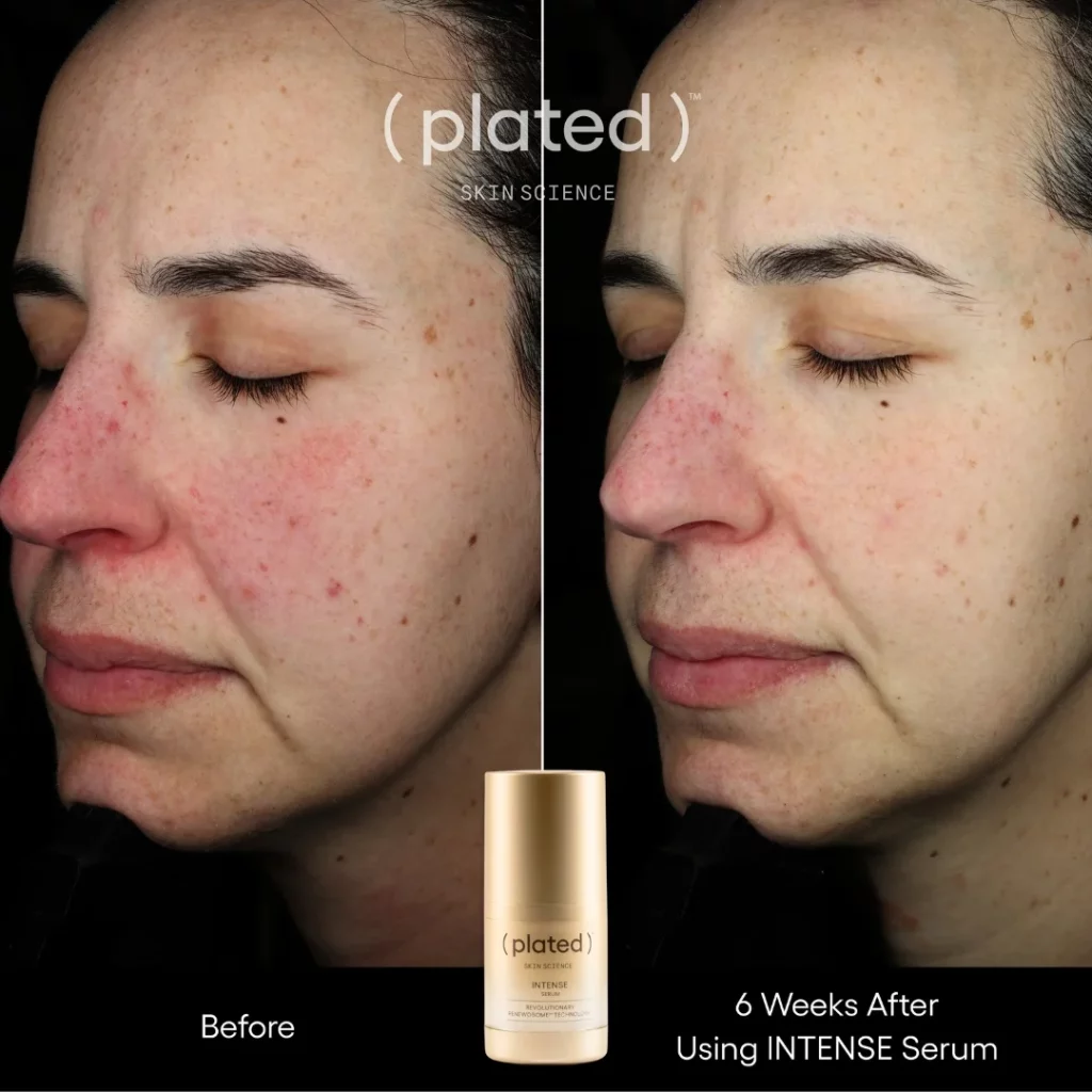 Before and After results of using Intense serum at White Coat Aesthetics in Las Vegas, NV