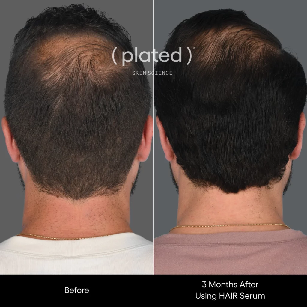 Before and After results of using hair serum at White Coat Aesthetics in Las Vegas, NV