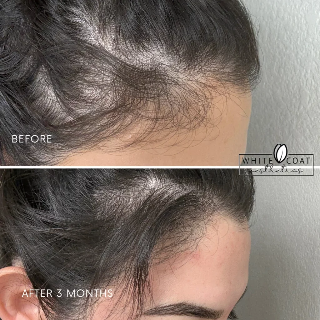 Before and After results of hair treatment at White Coat Aesthetics in Las Vegas, NV
