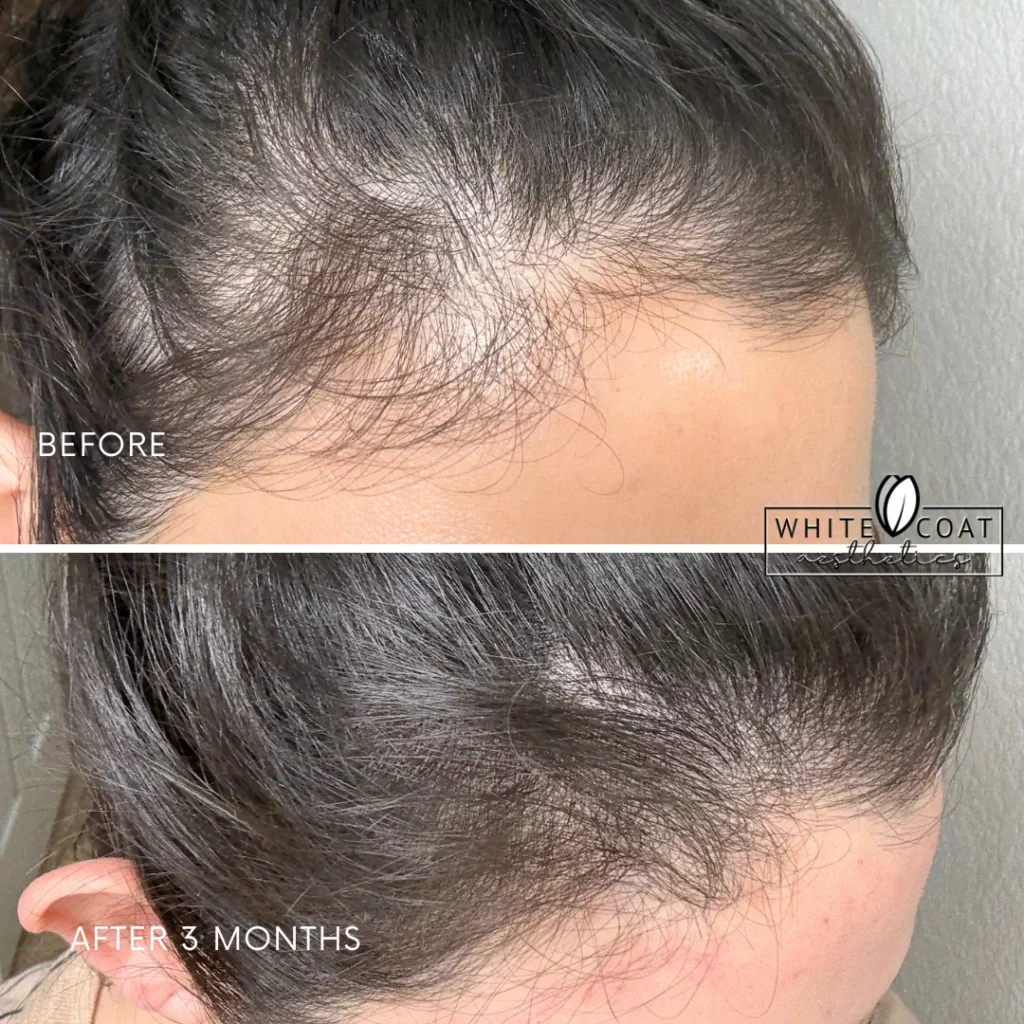 Before and After results of hair treatment at White Coat Aesthetics in Las Vegas, NV