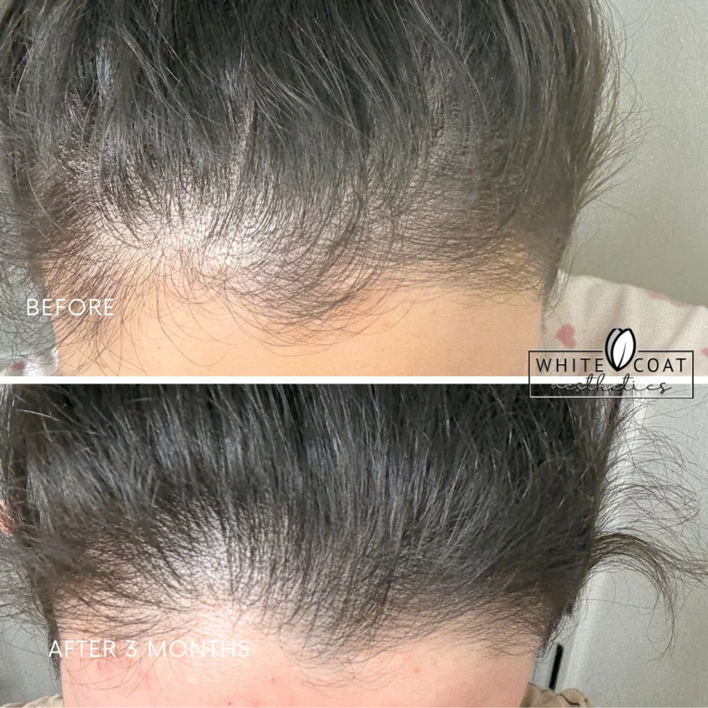 Before and After results of hair treatment at White Coat Aesthetics in Las Vegas, NV