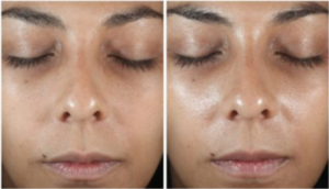 Woman Before and After DiamondGlow Treatment Photos in Las Vegas, NV | White Coat Aesthetics