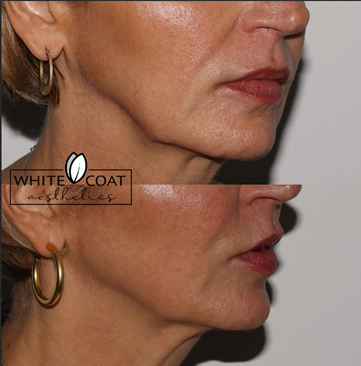 Before and After jawline filler Treatment Results of a female | White Coat Aesthetics in Las Vegas, NV