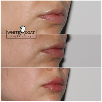 Before and After lip rehab Treatment Results of a woman | White Coat Aesthetics in Las Vegas, NV