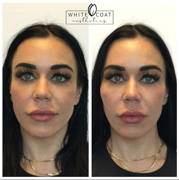 Before and After chin filler Treatment Results of a female | White Coat Aesthetics in Las Vegas, NV