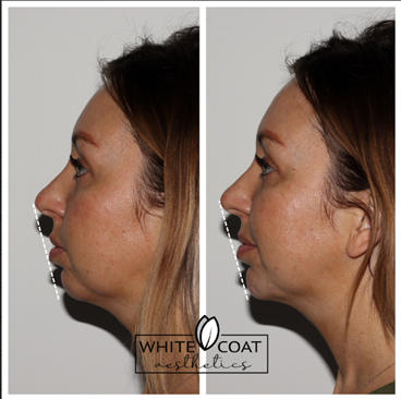 Before and After chin filler Treatment Results of a female | White Coat Aesthetics in Las Vegas, NV