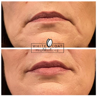 Before and After marionette line filler Treatment Results of a female | White Coat Aesthetics in Las Vegas, NV