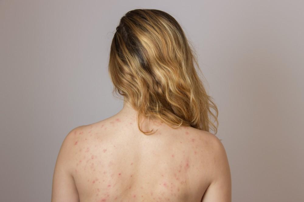 Woman Body with Acne | White Coat Aesthetics in Las Vegas, NV