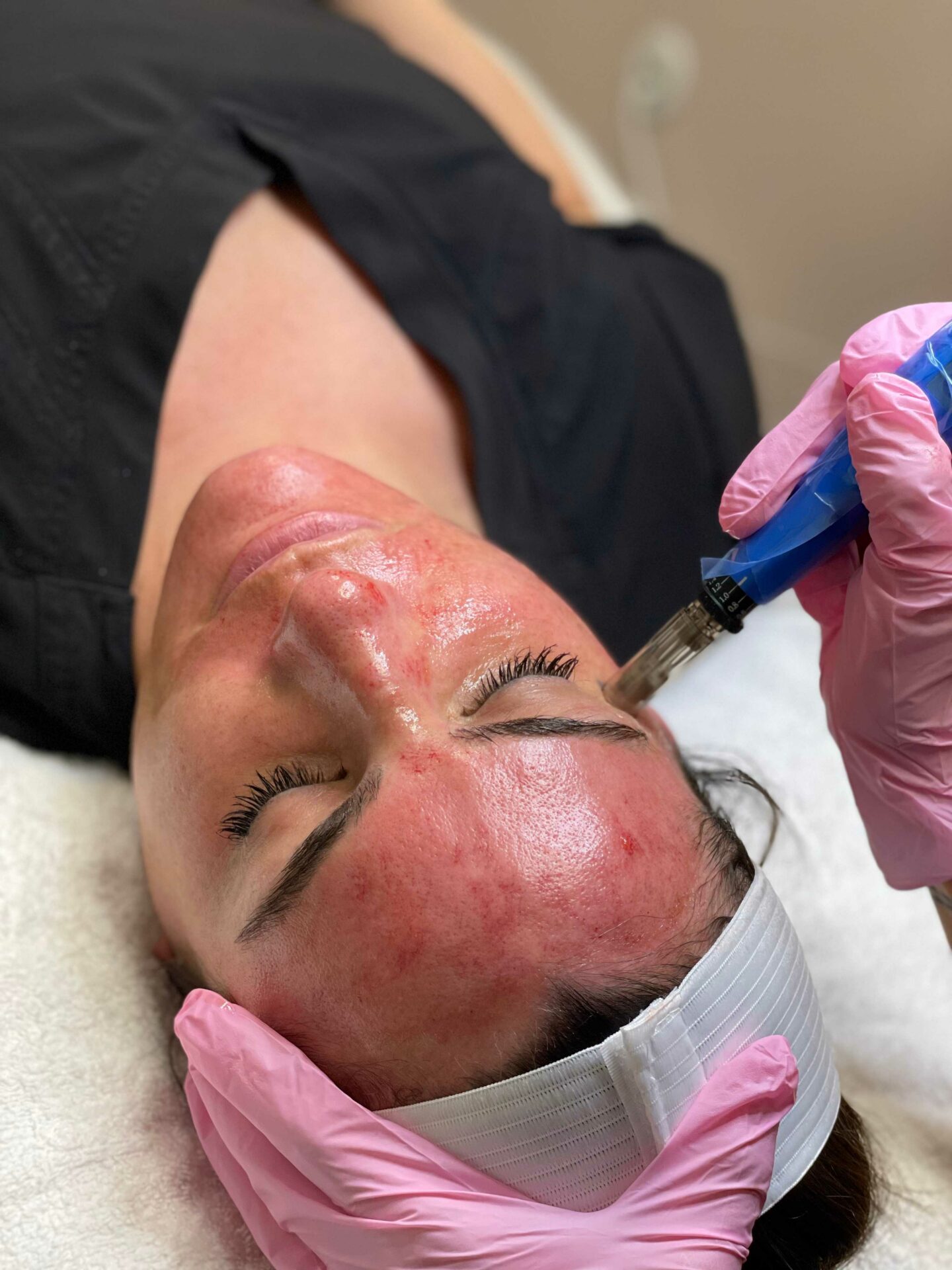 Microneedling Treatment at White Coat Aesthetics in Las Vegas, NV