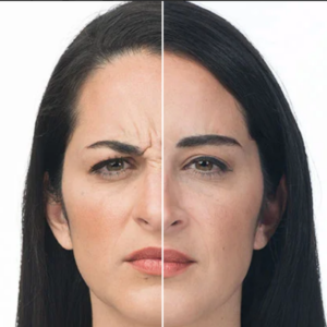 Young Woman Before and After Botox Treatment Photos in Las Vegas, NV | White Coat Aesthetics