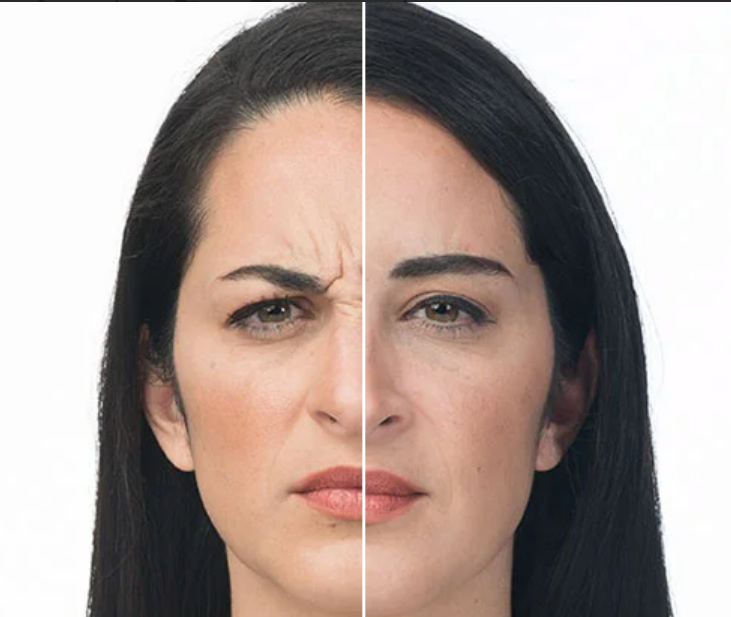 Young Woman Before and After Botox Treatment Photos in Las Vegas, NV | White Coat Aesthetics