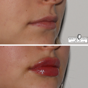 Young Woman Before and After Lip Filler Treatment Photos in Las Vegas, NV | White Coat Aesthetics