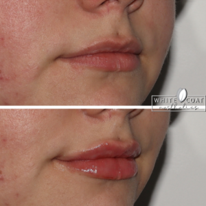 Young Woman Before and After Lip Filler Treatment Photos in Las Vegas, NV | White Coat Aesthetics